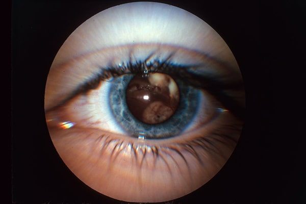 Ретинобластома